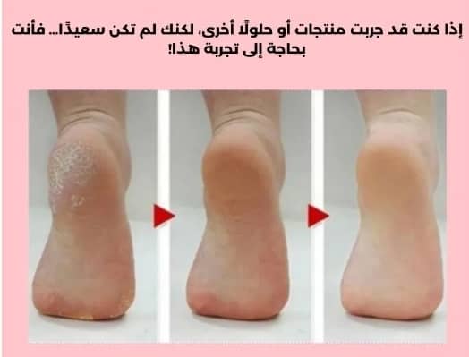 جهاز Flawless Pedi لإزالة الجلد الميت والقشرة بفعالية